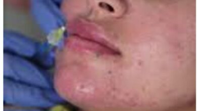 في مراكز نسائية..حروق وتشوهات بدل التجميل 7 IMG 20250122 WA0000