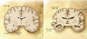الزهايمر: أكتر من مجرد نسيان 4 الزهايمر: أكتر من مجرد نسيان