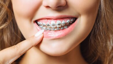 dental braces