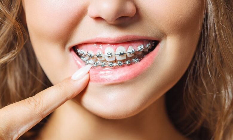 ما العلاقة بين تقويم الأسنان وجودة النوم..دراسة طبية تجيب 1 dental braces